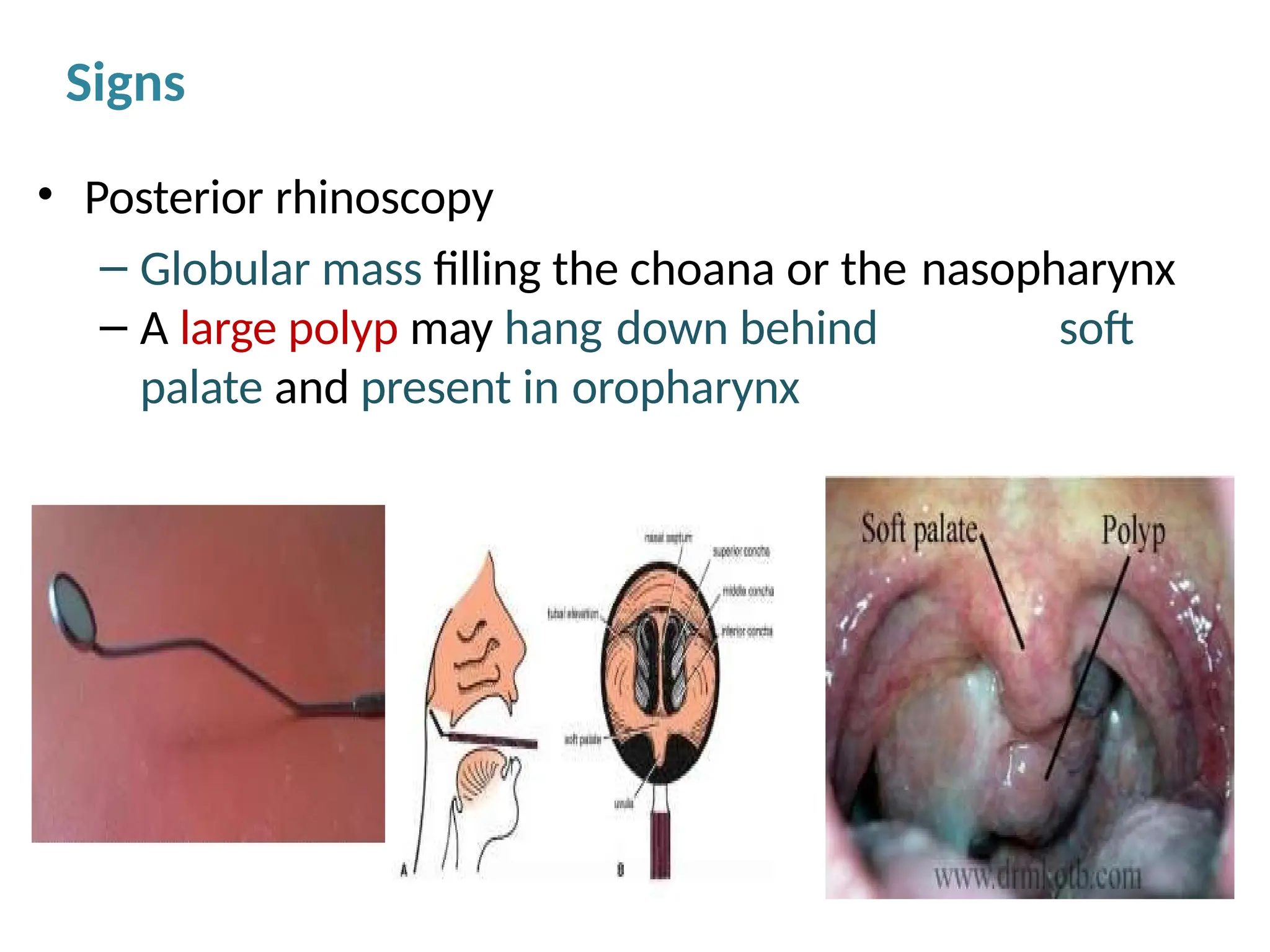 nasalpolypaedfawrstfgergdfbvcbergferf.pptx