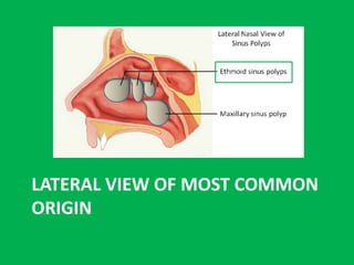 LATERAL VIEW OF MOST COMMON
ORIGIN
 