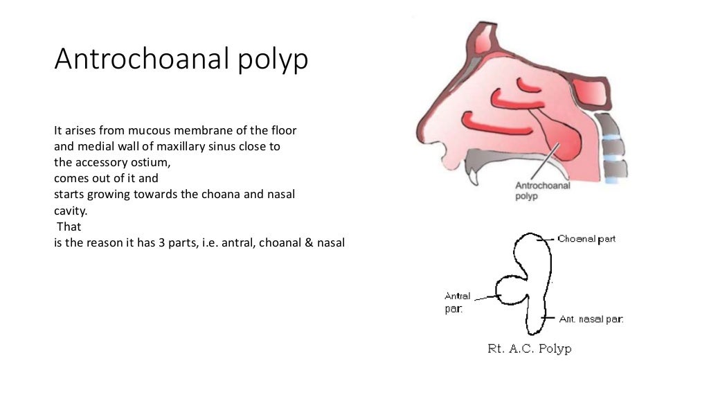 Nasal polypi otorhinolaryngology types etiology management ent ppt