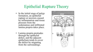 Epithelial Rupture Theory
• In the initial stage of polyp
formation, an epithelial
rupture or necrosis caused
by inflammation and tissue
pressure from the
oedematous and infiltrated
lamina propria takes place.
• Lamina propria protrudes
through the epithelial
defect, and the adjacent
epithelium tends to cover
the defect by migrating
from the surroundings.
 