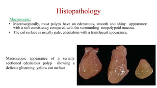 Histopathology
Macroscopic:
• Macroscopically, most polyps have an edematous, smooth and shiny appearance
with a soft consistency compared with the surrounding nonpolypoid mucosa.
• The cut surface is usually pale, edematous with a translucent appearance.
Macroscopic appearance of a serially
sectioned edematous polyp showing a
delicate glistening yellow cut surface
 