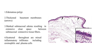 1.Edematous polyp
2.Thickened basement membranes
(arrows)
3.Marked submucosal edema resulting in
extensive clear space between
submucosal connective tissue fibers.
4.Scattered throughout are mixed
inflammatory infiltrates including
eosinophils and plasma cells
 