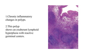 1.Chronic inflammatory
changes in polyps.
2.This polyp
shows an exuberant lymphoid
hyperplasia with reactive
germinal centers.
 