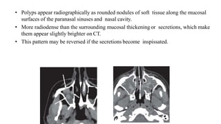 • Polyps appear radiographically as rounded nodules of soft tissue along the mucosal
surfaces of the paranasal sinuses and nasal cavity.
• More radiodense than the surrounding mucosal thickening or secretions, which make
them appear slightly brighter on CT.
• This pattern may be reversed if the secretions become inspissated.
 