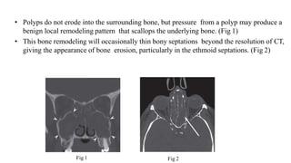 • Polyps do not erode into the surrounding bone, but pressure from a polyp may produce a
benign local remodeling pattern that scallops the underlying bone. (Fig 1)
• This bone remodeling will occasionally thin bony septations beyond the resolution of CT,
giving the appearance of bone erosion, particularly in the ethmoid septations. (Fig 2)
Fig 1 Fig 2
 