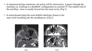 • In antronasal polyps sometimes, the polyp will be narrowed as it passes through the
maxillary os, resulting in a dumbbell configuration on coronal CT. The medial wall of
the maxillary sinus is usually bowed into the nasal cavity. (Fig 1)
• In antrochoanal polyp the most helpful radiologic feature is the
mass itself extending into the nasopharynx. (Fig 2)
Fig 1 Fig 2
 
