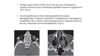 • Allergic fungal sinusitis (AFS). On CT, the presence of hyperdense
secretions between layers of thickened, hypodense mucosa is suggestiveof
AFS. (Fig 1)
• Inverted papillomas are often indistinguishable from polyps
radiographically. A lobular (“cerebriform”) configuration is alsosuggestive
of papilloma. Bony sclerosis and osteoneogenesis are frequently present at
the site of attachment of inverted papillomas. (Fig 2)
Fig 1 Fig 2
 