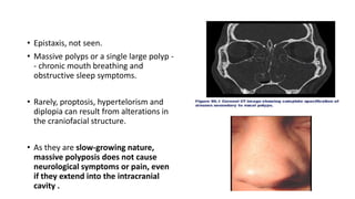 • Epistaxis, not seen.
• Massive polyps or a single large polyp -
- chronic mouth breathing and
obstructive sleep symptoms.
• Rarely, proptosis, hypertelorism and
diplopia can result from alterations in
the craniofacial structure.
• As they are slow-growing nature,
massive polyposis does not cause
neurological symptoms or pain, even
if they extend into the intracranial
cavity .
 