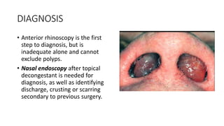 DIAGNOSIS
• Anterior rhinoscopy is the first
step to diagnosis, but is
inadequate alone and cannot
exclude polyps.
• Nasal endoscopy after topical
decongestant is needed for
diagnosis, as well as identifying
discharge, crusting or scarring
secondary to previous surgery.
 
