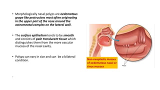 • Morphologically nasal polyps are oedematous
grape like protrusions most often originating
in the upper part of the nose around the
osteomeatal complex on the lateral wall.
• The surface epithelium tends to be smooth
and consists of pale translucent tissue which
distinguishes them from the more vascular
mucosa of the nasal cavity.
• Polyps can vary in size and can be a bilateral
condition.
.
 