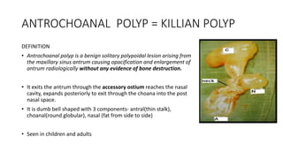 ANTROCHOANAL POLYP = KILLIAN POLYP
DEFINITION
• Antrochoanal polyp is a benign solitary polypoidal lesion arising from
the maxillary sinus antrum causing opacification and enlargement of
antrum radiologically without any evidence of bone destruction.
• It exits the antrum through the accessory ostium reaches the nasal
cavity, expands posteriorly to exit through the choana into the post
nasal space.
• It is dumb bell shaped with 3 components- antral(thin stalk),
choanal(round globular), nasal (fat from side to side)
• Seen in children and adults
 