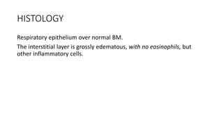 HISTOLOGY
Respiratory epithelium over normal BM.
The interstitial layer is grossly edematous, with no eosinophils, but
other inflammatory cells.
 