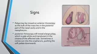 Signs
• Polyp may be missed on anterior rhinoscopy
as the bulk of the mass lies in the posterior
part of the nasal cavity and in the
nasopharynx.
• posterior rhinoscopy will reveal a large polyp,
which is pale white and translucent in the
choana of the affected side. Sometimes it
comes out into the oropharynx, pushing the
soft palate downwards.
 