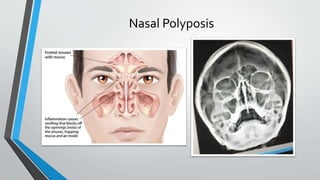 Nasal Polyposis
 