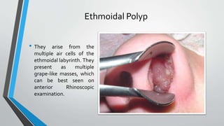 Ethmoidal Polyp
• They arise from the
multiple air cells of the
ethmoidal labyrinth. They
present as multiple
grape-like masses, which
can be best seen on
anterior Rhinoscopic
examination.
 