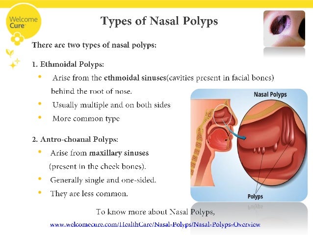 Nasal Polyp Obstructing Your Health? Breathe Easy with Homeopathy!