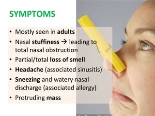 SYMPTOMS
• Mostly seen in adults
• Nasal stuffiness  leading to
total nasal obstruction
• Partial/total loss of smell
• Headache (associated sinusitis)
• Sneezing and watery nasal
discharge (associated allergy)
• Protruding mass
 