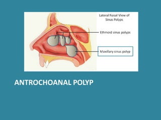 ANTROCHOANAL POLYP
 