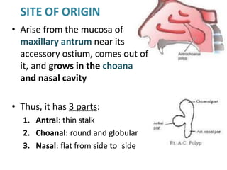 SITE OF ORIGIN
• Arise from the mucosa of
maxillary antrum near its
accessory ostium, comes out of
it, and grows in the choana
and nasal cavity
• Thus, it has 3 parts:
1. Antral: thin stalk
2. Choanal: round and globular
3. Nasal: flat from side to side
 