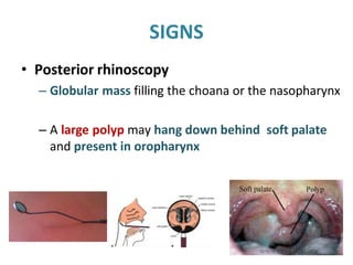 SIGNS
• Posterior rhinoscopy
– Globular mass filling the choana or the nasopharynx
– A large polyp may hang down behind soft palate
and present in oropharynx
 