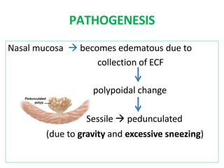 PATHOGENESIS
Nasal mucosa  becomes edematous due to
collection of ECF
polypoidal change
Sessile  pedunculated
(due to gravity and excessive sneezing)
 
