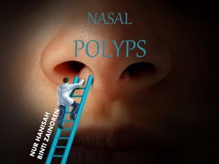 NASAL
POLYPS
 