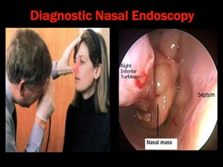 Diagnostic Nasal Endoscopy
 