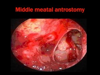 Middle meatal antrostomy
 