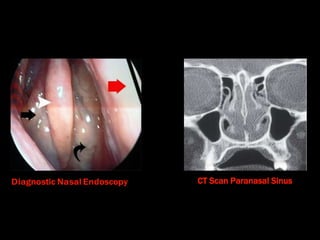 CT Scan Paranasal Sinus
 