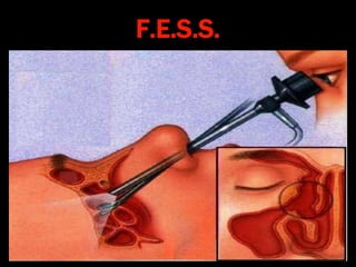F.E.S.S.
 