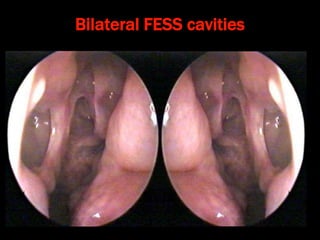 Bilateral FESS cavities
 