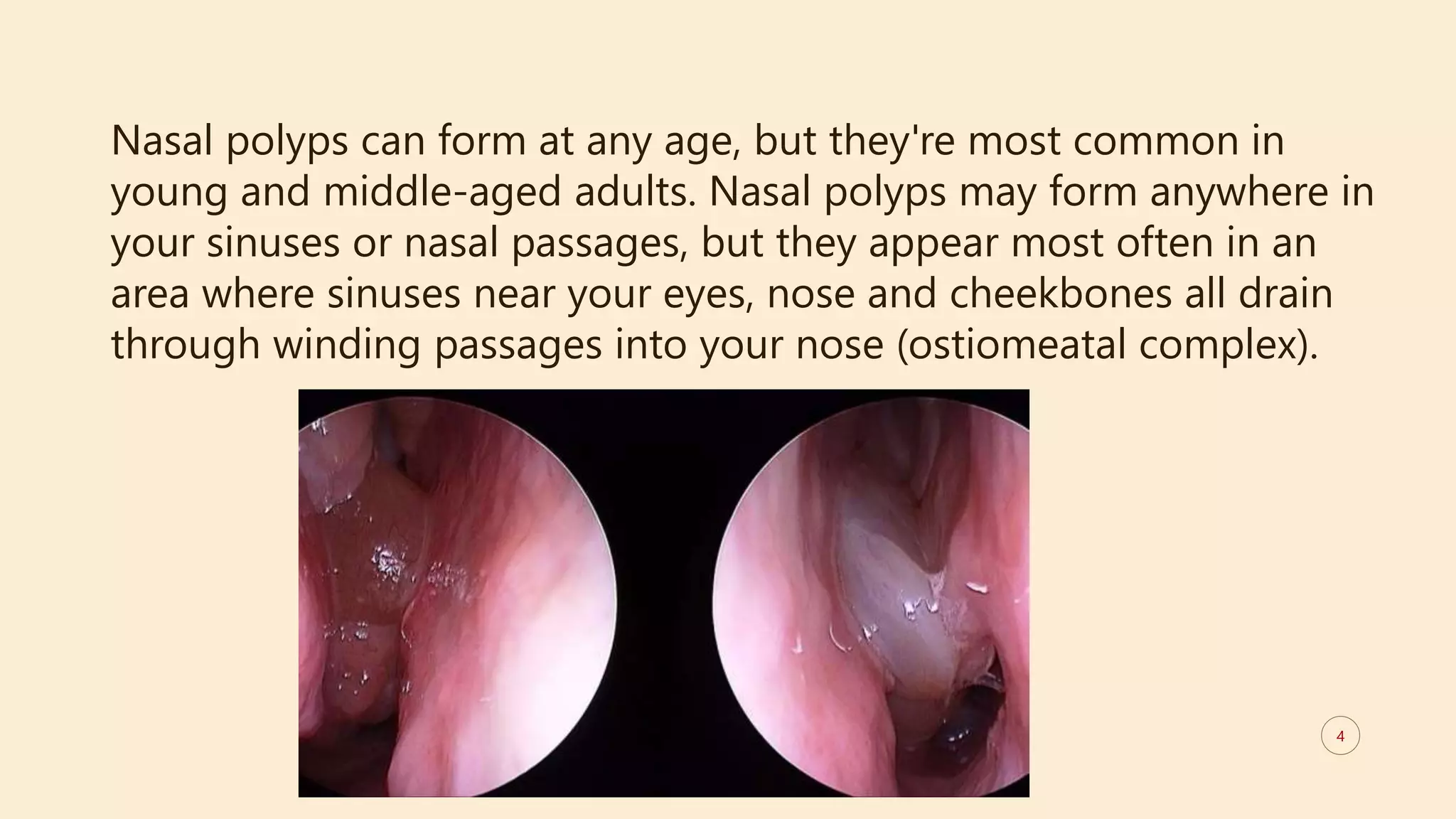Nowe Polyp Nasal polyps - a detailed medical study | PPTX