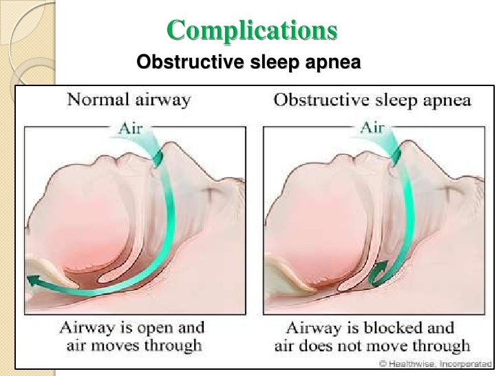 obstructive nasal polyps