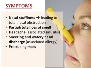SYMPTOMS
• Nasal stuffiness  leading to
total nasal obstruction
• Partial/total loss of smell
• Headache (associated sinusitis)
• Sneezing and watery nasal
discharge (associated allergy)
• Protruding mass
 