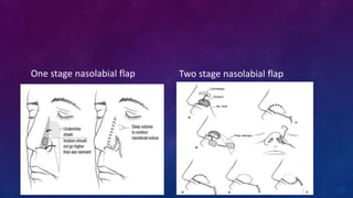 One stage nasolabial flap Two stage nasolabial flap
 
