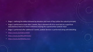 • Stage 1: defining the defect followed by elevation and inset of flap (utilise the subunit principle)
• Stage 2: performed at least after 3 weeks, flap is elevated off of its nasal bed at a superficial
subcutaneous level of 2-3mm in thickness leaving the supratrochlear pedicle intact
• Stage 3: performed after additional 3 weeks, pedicle devision is performed along with debulking
• https://youtu.be/EQK1vniIkD0
• https://youtu.be/BRxuMFD3v6U
• https://youtu.be/MGdAay-Gcrs
 