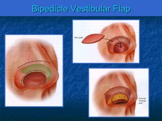 Nasalreconstructiongrandrounds043009 | PPT