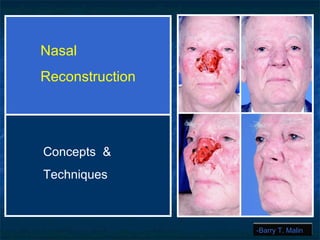 -Barry T. Malin Nasal  Reconstruction Concepts  & Techniques 