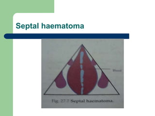 Septal haematoma
 