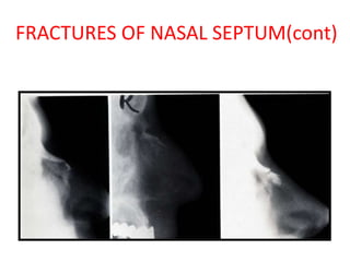 Nasal Septum and its Diseases | PPT