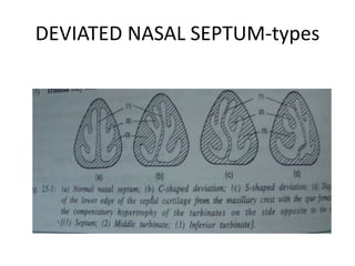 DEVIATED NASAL SEPTUM-types
 