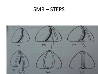 SMR – STEPS
 