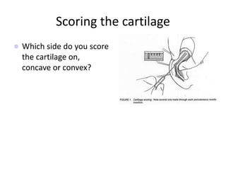 Scoring the cartilage
 Which side do you score
the cartilage on,
concave or convex?
 