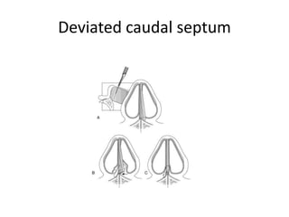 Deviated caudal septum
 