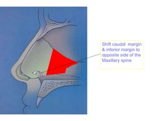 Shift caudal margin
& inferior margin to
opposite side of the
Maxillary spine
 