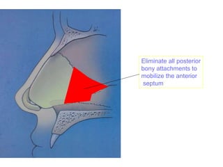 Eliminate all posterior
bony attachments to
mobilize the anterior
septum
 
