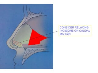 CONSIDER RELAXING
INCISIONS ON CAUDAL
MARGIN
 