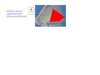 1.Anterior septum
separated from
Vomer and Ethmoid
 