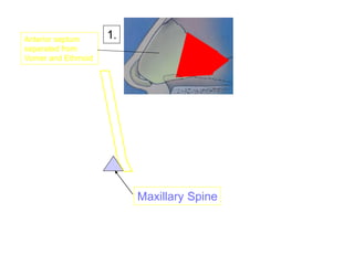 Maxillary Spine
1.Anterior septum
separated from
Vomer and Ethmoid
 