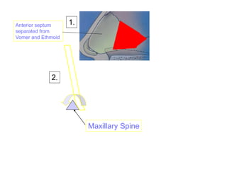 Maxillary Spine
1.
2.
Anterior septum
separated from
Vomer and Ethmoid
 